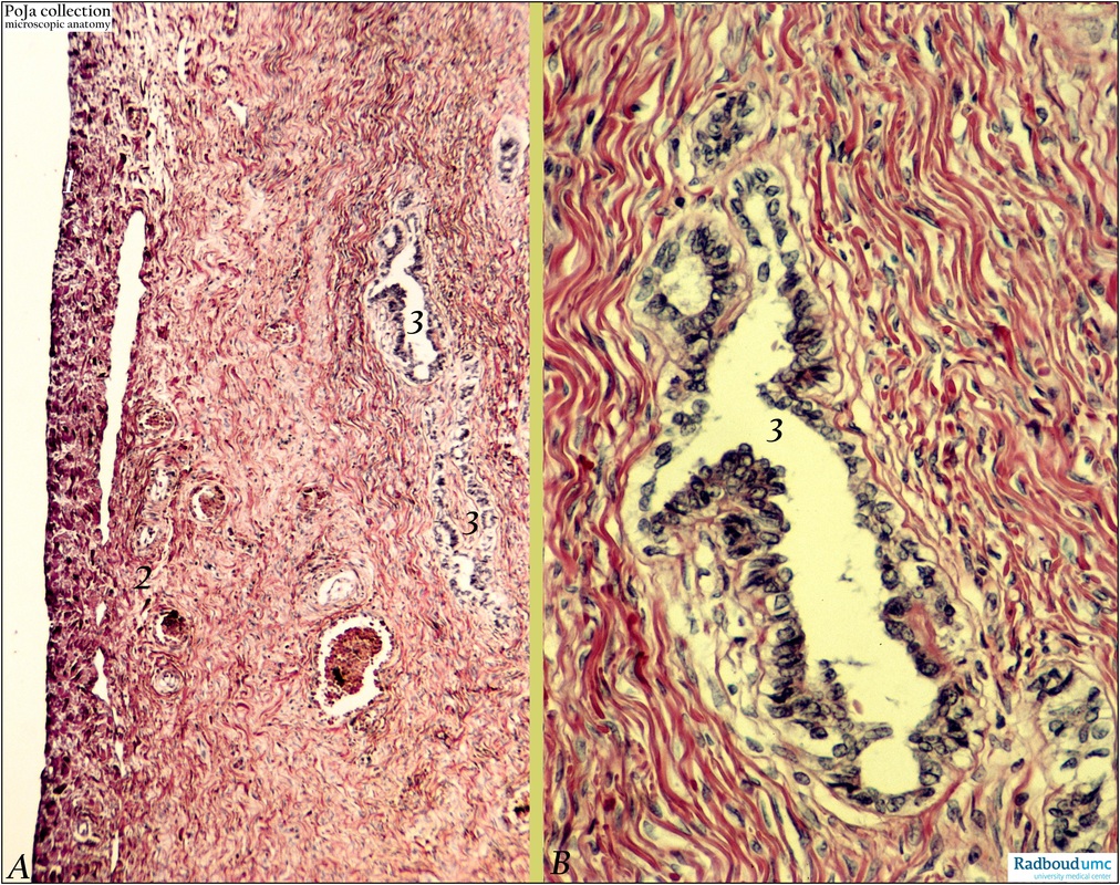 Epithelial inclusion cysts in the ovary