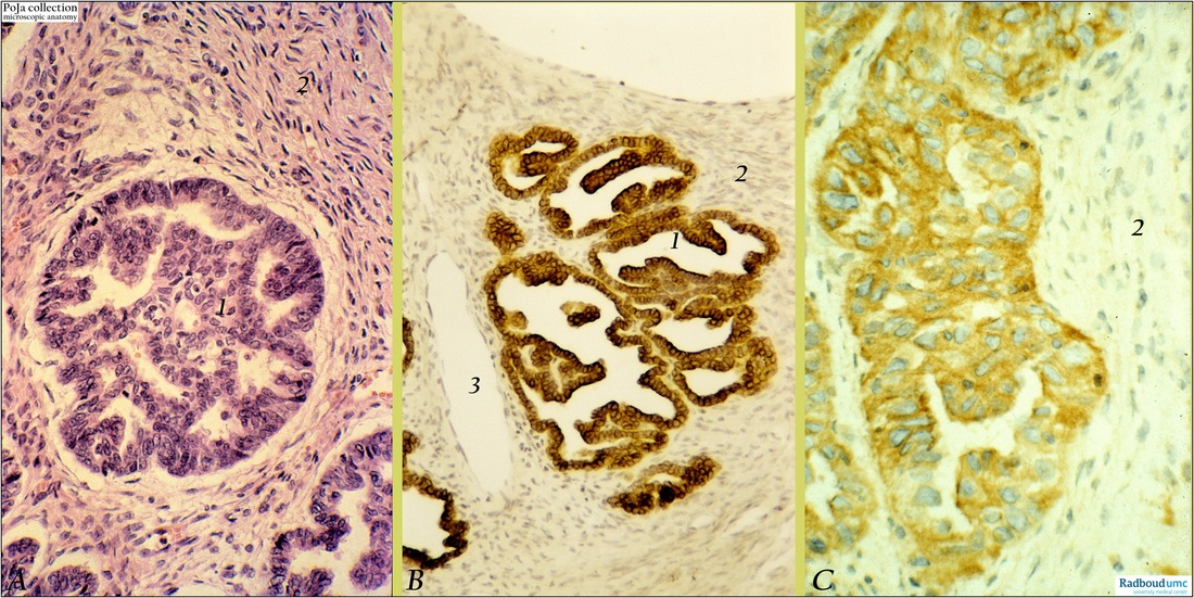 Papillary serous adenocarcinoma of ovary (human)