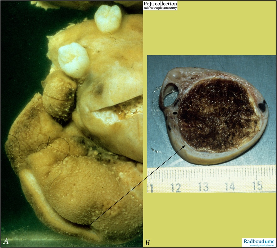 Mature cystic teratoma of the ovary