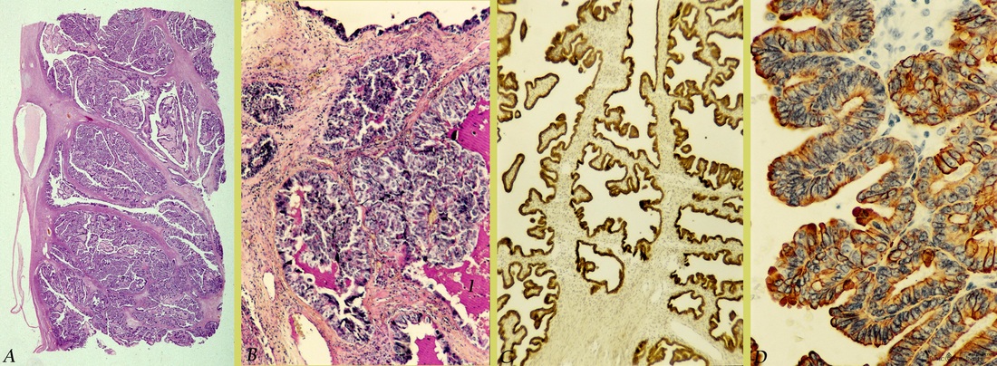 Papillary serous cystadenocarcinoma of ovary (human, adult)