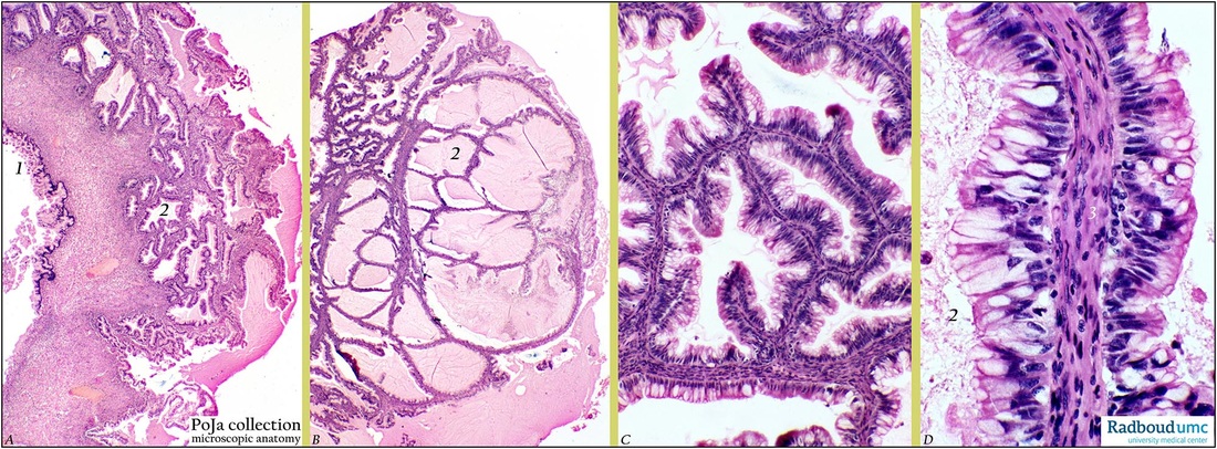 Mucinous cystadenocarcinoma of ovary
