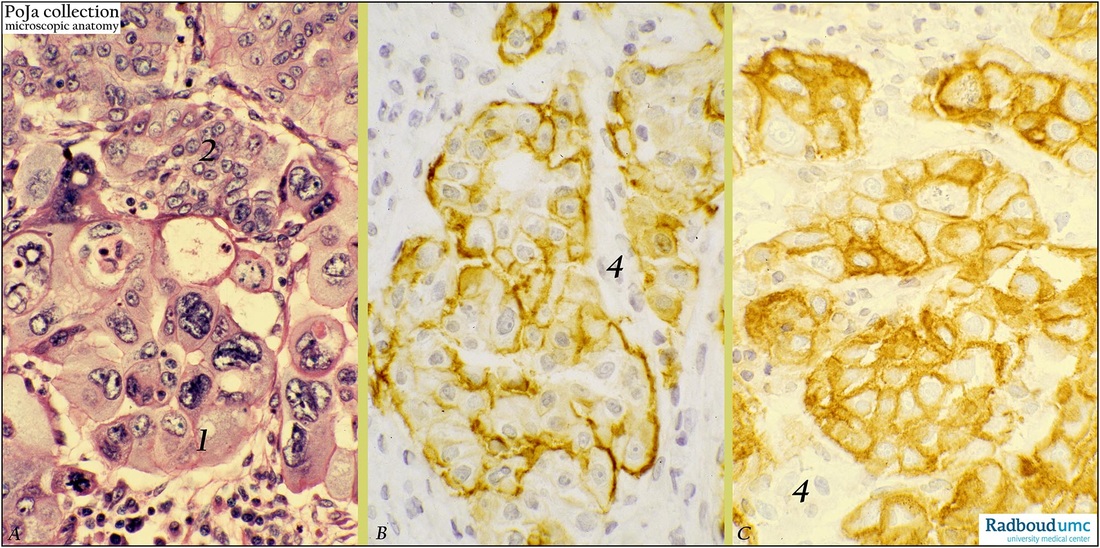 Papillary serous cystadenocarcinoma of ovary