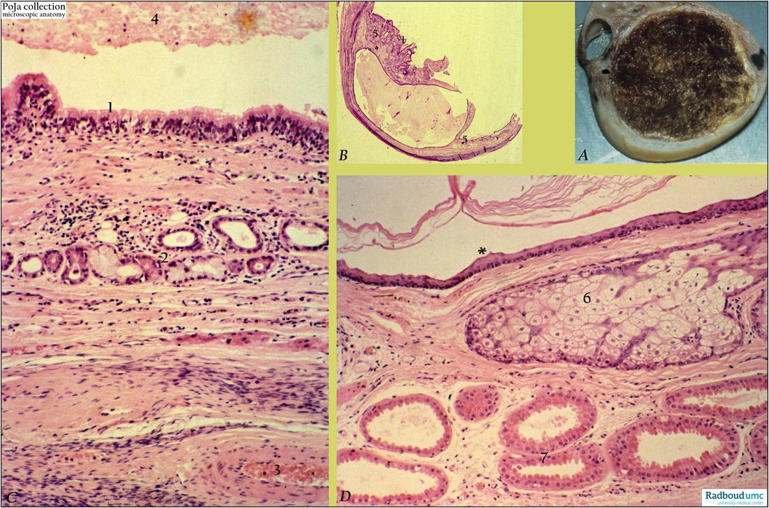 Mature cystic teratoma of the ovary, human