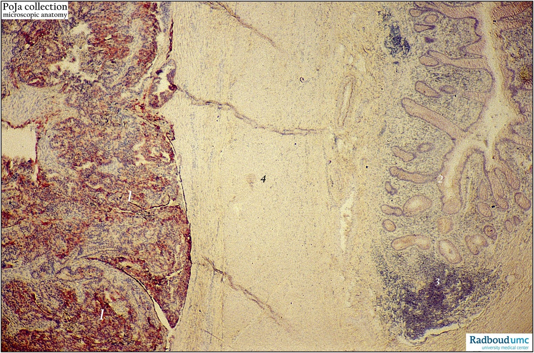 Serous adenocarcinoma of ovary